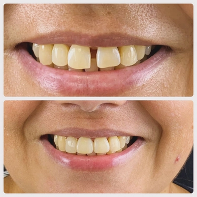 Facetas e clareamento dental