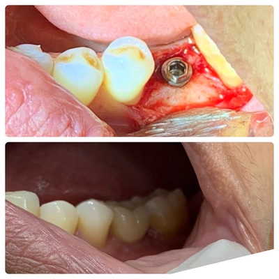 Implante dental