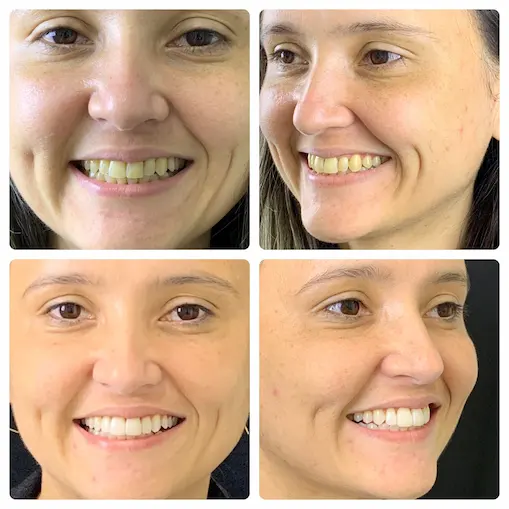 Facetas e clareamento dental