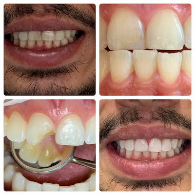 Facetas, reatauração e clareamento dental